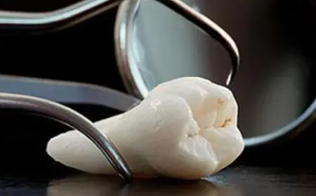 أضراس العقل.. متى يجب أن تقلع؟